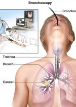 Bronchoscopy11