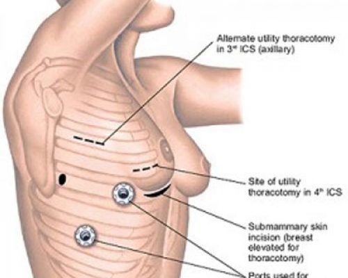 Thoracoscopy