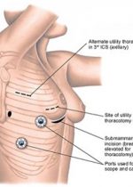 Thoracoscopy