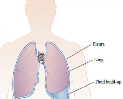 Thoracoscopy2