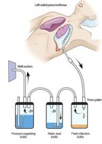 chest-tube