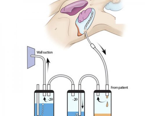 chest-tube chest-tube