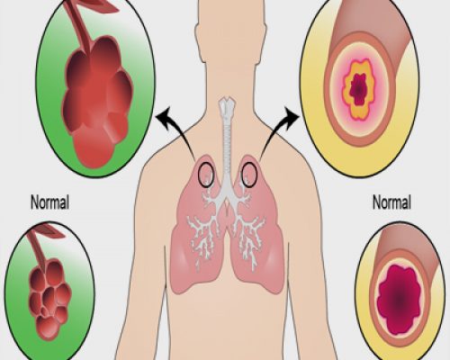 copd01 copd01
