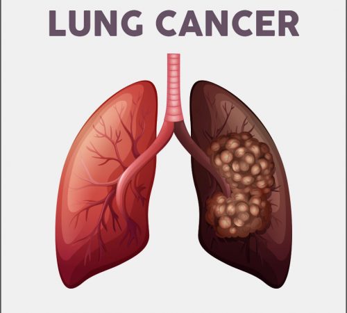 lungcancer01 lungcancer01