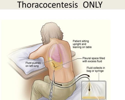 pleural-aspiration pleural-aspiration