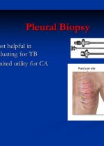 pleural-biopsy