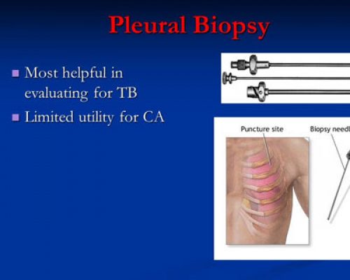 pleural-biopsy pleural-biopsy