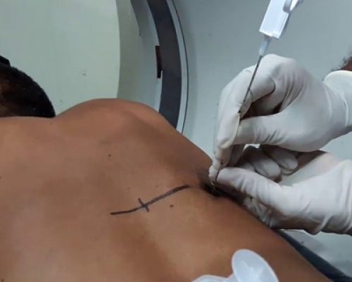 pleural-biopsy4