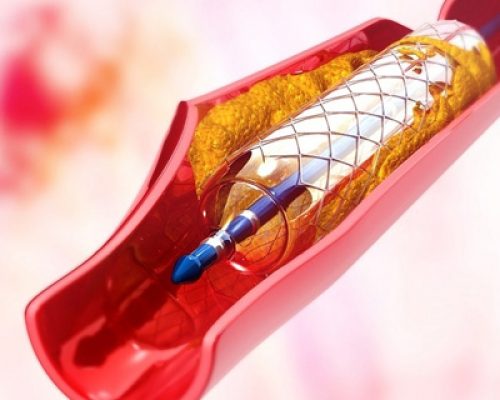 tracheobronchial-stents5
