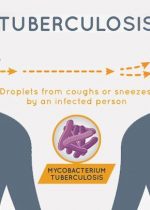 tuberculosis