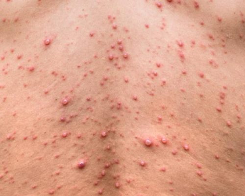 vaccination1