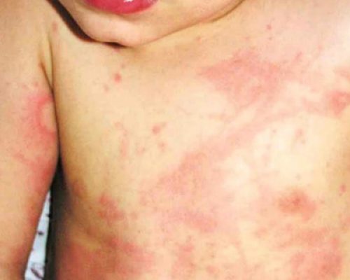 vaccination2
